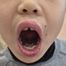 함께웃는치과의원 | 원주 어린이치과 추천 - 9살 막내 교정 시작!다람쥐키즈치과 솔직 후기 (내돈내산)