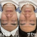 모도리브로우 | 태평역 윤곽관리 모도리브로우 빼빼턱 관리 단 1회 만으로 놀라운 차이가 난다?