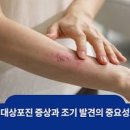 대상포진 초기 증상 발진이 나타나면 72시간 이내 항바이러스제를 복용하는 것이 좋다 이미지