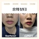 지에스(GS)25 동구영조뷰티점 | 대구 동구 반영구 홍화뷰티 자연스러운 틴트입술 솔직후기(과정/주의사항/탈각)