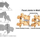 요추 - 후관절 증후군 이미지