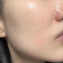 중일약국 | 약국 여드름 에크논 크림 화농성 좁쌀 흉터 색소침착 관리 종류별 연고