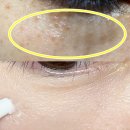 배약국 | 약국 비립종 연고 사용후기 (내돈내산)