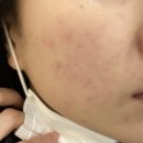 부천아이스피부과의원 | 부천 톤즈의원 피부과 내돈내산 베이직 여드름관리 5회 후기 (비추)