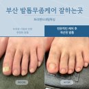 부산발톱무좀 관리후기 전문케어해주는 프리앤드네일왁싱