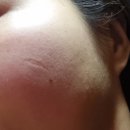 차서역침한의원 | 천안아산 패인흉터 치료 2회차 한의원 새살침 후기