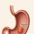 위암 초기증상과 예방법, 조기검진이 살 길입니다