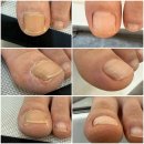 케어솔루션 | 안산 발톱무좀 변색도 말끔 케어한 네일솔루션 후기