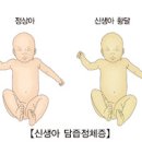 신생아 담도 폐쇄증 원인, 증상, 진단 및 치료 이미지