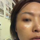 피부를 벗기지 않고 되살리는 필링? (청담바이오필링 후기)