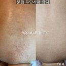 볼리아 송파점 | 등드름 등착색자국 서울알라딘필링 2회차 필링 재생 깨끗해진등 리얼 후기 볼리아송파점