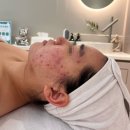범계피부관리 제이더블유메디스킨 성인여드름 개선 후기