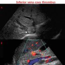 Inferior vena cava thrombus 이미지