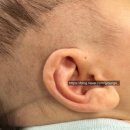 나은필병원 | 소아과에서 교정하다가 강남세브란스 병원 가게 된 이유, 강남세브란스 귀교정, 신생아 접힌 귀 교정...