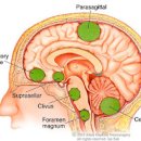 뇌수막종 증상 및 수술 (간질발작, 복시, 언어장애) 이미지