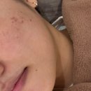 목동2 | 목동피부과 큐어젯 2회차 솔직 후기: 갑자기 생긴 흉터, 패인자국 드디어 차오르다!