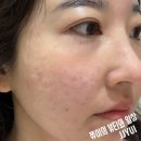 미소페이스 | 피부과 쥬베룩 스킨 8cc + 물광보톡스(풀페이스) 내돈내산 솔직후기 (효과, 통증, 엠보 7일차 변화 총정리)