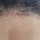 부산맥스웰피부과의원 | [종로/종각] 맥스웰피부과 종로 (18회+12회) 탈모치료 내돈내산 후기