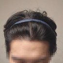 모제림외과의원 | 모제림성형외과 모발이식 1년차 후기