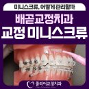 청학현대치과의원 | 배곧 근처 교정치과 교정 미니스크류 식립 및 관리방법