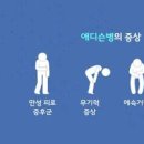 부신 기능저하증 피로증후군 부신피질호르몬 역할 검사 에디슨병 쿠싱증후군 원인 증상 이미지
