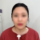 [찐 내돈내산] 울쎄라피 프라임 600샷 턱선, 볼좀 땡겨봤음 뿌뿌 🎺 l 동탄 에미뜨 의원