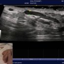 Hot Tips - Testicular Ultrasound for Varicocele 이미지