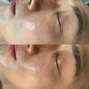 알티드 | 광주 상무지구 모공 여드름 문제성피부 고민 하이플라즈마로 해결 에스테틱다정