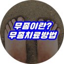 ﻿무좀이란??//무좀 치료하는방법 이미지