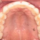 안종우통합치과의원 | 미사치과 무너진 치열 복원하는 전체 네비게이션 임플란트 치료 과정 및 후기