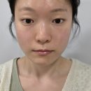 씨유 신기부은점 | 내돈내산 압구정피부과 볼패임 필업 콜라겐주사 솔직 후기 부작용