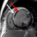 H1439 | Case Study_848:운동 시 가슴통증_협심증(Angina Pectoris)을 의심하라