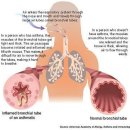 만성 폐쇄성 호흡기질환(Chromic dostructive pulmonary disease:COPD) 이미지