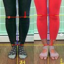 웨돔 필라테스 오다리 체형 교정 후기