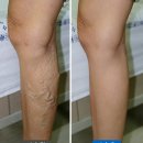 인천 하지정맥류 수술 후기 좋은곳 5