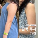 더서울병원 | 팔뚝 지방분해주사 가격 서울 다이어트 병원 후기