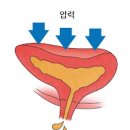 요실금 증상 과 원인 복압성요실금 수술 or 케겔운동 이미지