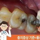 충치 치료 단계 증상과 통증에 대하여 이미지