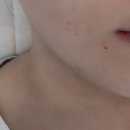 시원더스킨 | 마곡에스테틱 ‘온더스킨’ 여드름 관리 후기 (붉은기 진정관리)