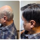 다모아코리아 | 성북구 장위동 고객님 첫 맞춤가발 후기 통풍 좋은 성형가발과 벨크로 고정으로 편안함 UP