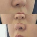 2차는 | 부산 센텀피부과 팔자 미희주사 2차, 내돈내산 후기