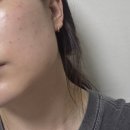웨딩 본식준비 :: 청주 치과연어주사 리쥬란HB+ 1회차 2cc 후기 (통증, 소요시간, 주의사항) + 1일차...