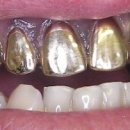 골드크라운 이미지