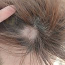 세솔메디컬의원 | 원형탈모가 와버렸다.. 초기병원비, 치료비, 실비, 주사비용 탈모초기