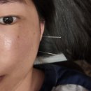 파동한의원 | [분당] 분당얼굴비대칭교정후기 /분당안면비대칭 한의원에서 턱관절 및 광대 교정한 실제후기