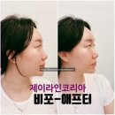 코리아세븐 대구종로2가점 | 대구 리프팅전문 무통리프팅 제이라인코리아 에어젯리프팅 가격