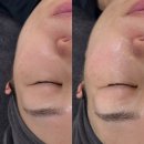 인크리즈 | ✨인크리즈 스킨부스터 MTS 관리 후기 / PN리젠 + 히알알파 앰플💧