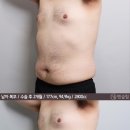 남자 복부지방흡입 후기 남깁니다 75일정도 지났어요 / 복부지방흡입 이미지