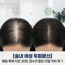 송내바로약국 | ​[송내 여성 두피문신] 매일 정수리에 흑채 쓰다 지친 30대 고객님의 리얼 탈모 커버 후기
