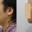 씨엘의원 | [공지] 이마 필러 후기, 여의사가 직접 받아본 후기(ft. 엘란쎄)